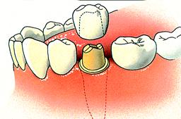 Tandheelkundige kroon