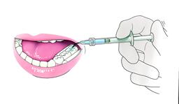 seal reinigen en etsen
